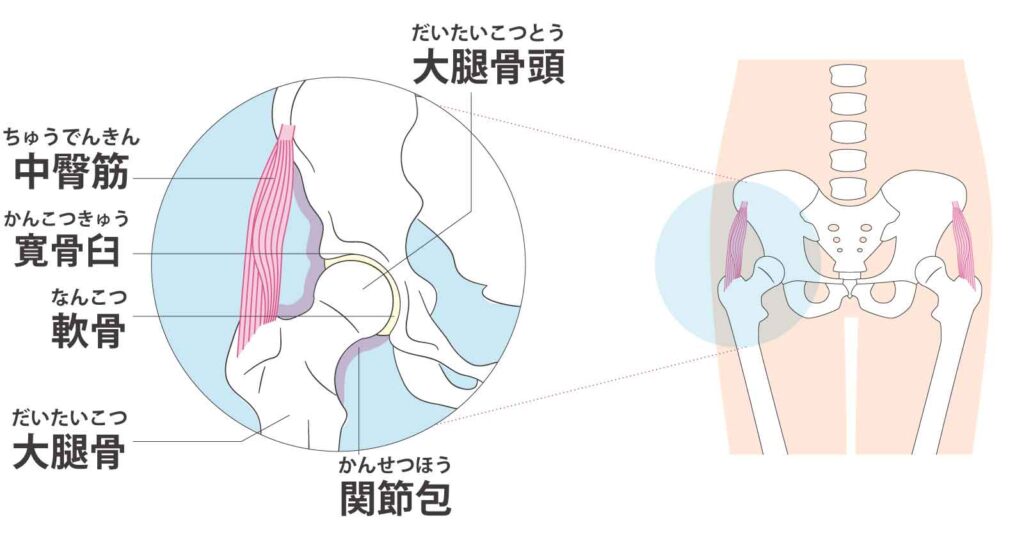大腿骨頸部疲労骨折の原因