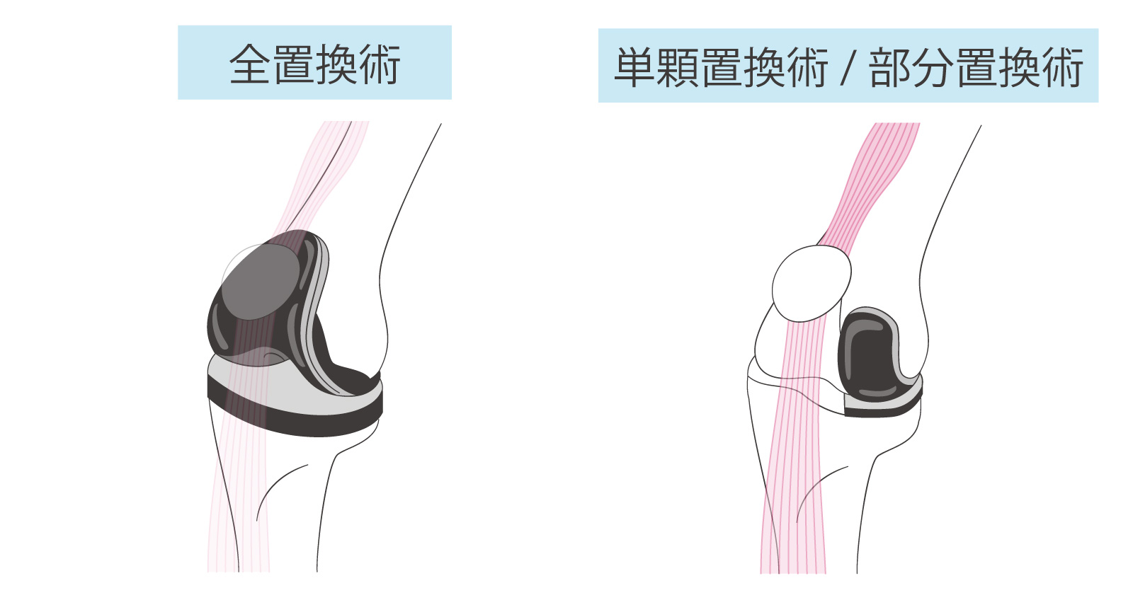 人工 膝 関節: 膝置換術 _ 整形外科 医師紹介｜浜松医科大学医学部附属病院 – SRNGI